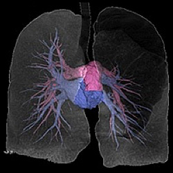肺動静脈CTA