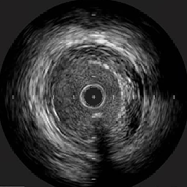 血管内超音波 IVUS