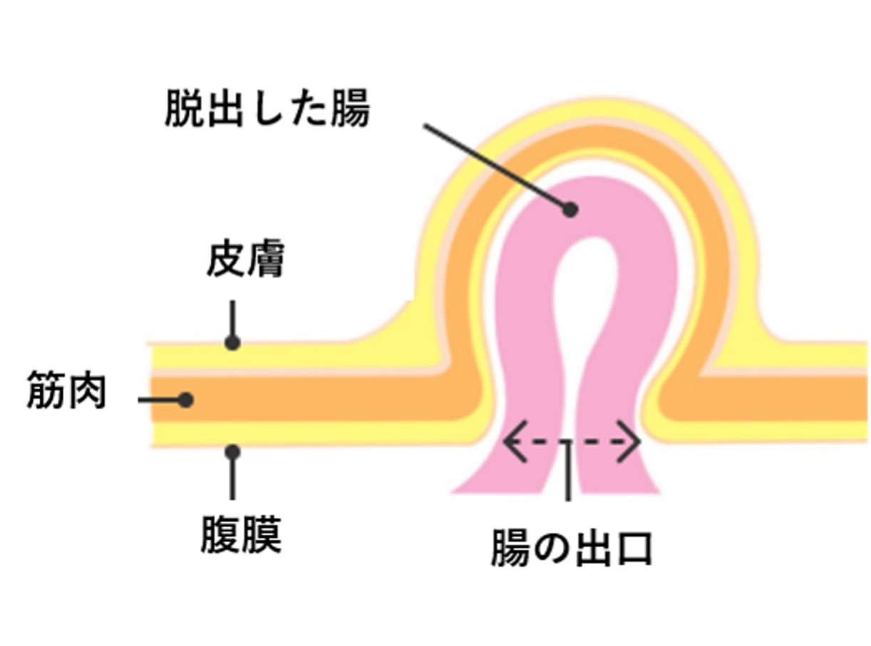 腹部ヘルニアのイメージ