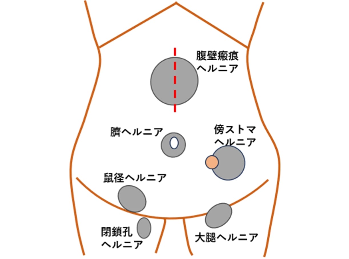 主な腹部ヘルニア