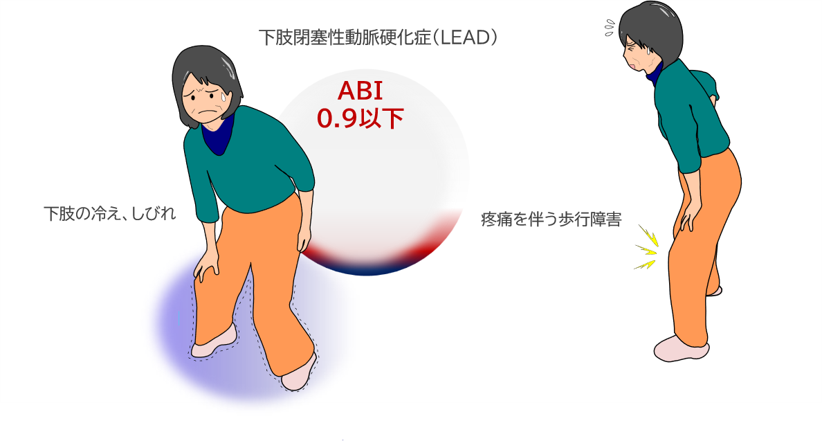 下肢閉塞性動脈硬化症イメージ