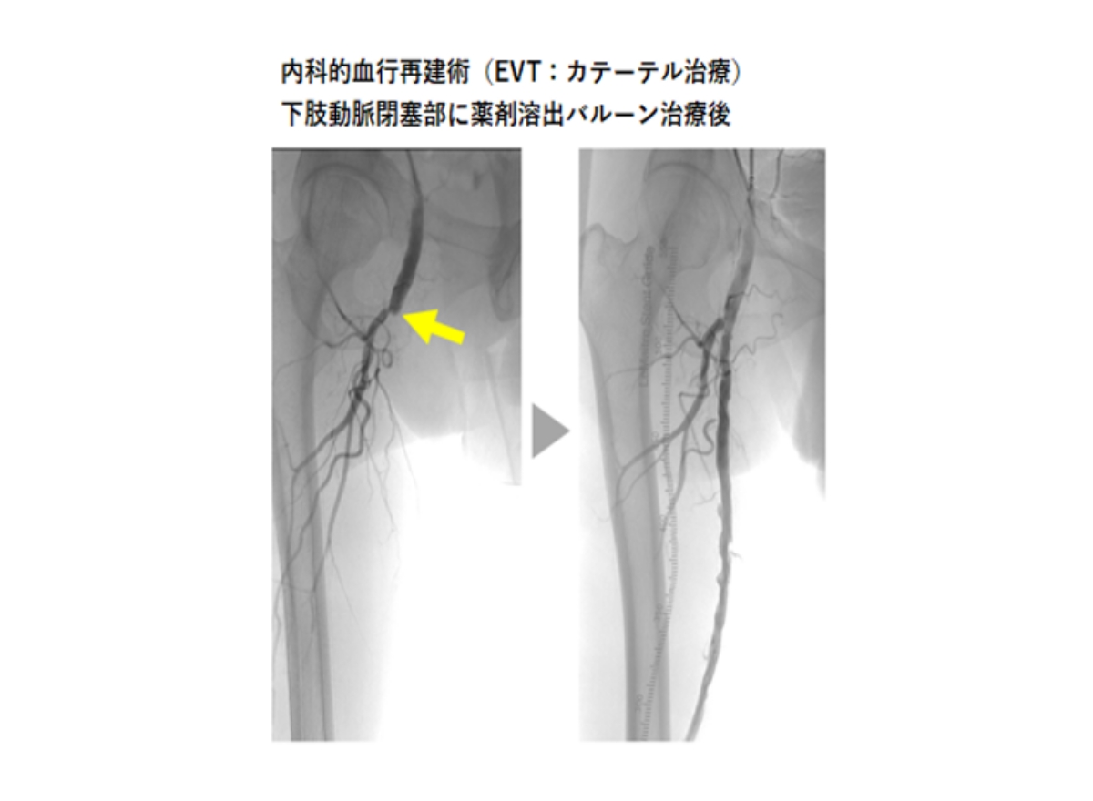 内科的血行再建術