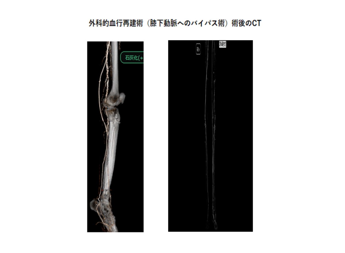 外科的血行再建術