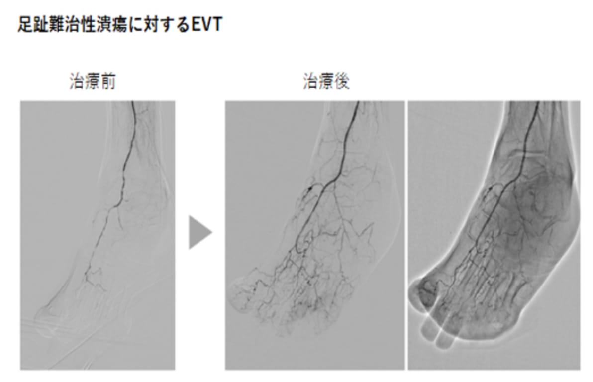 足趾難治性潰瘍