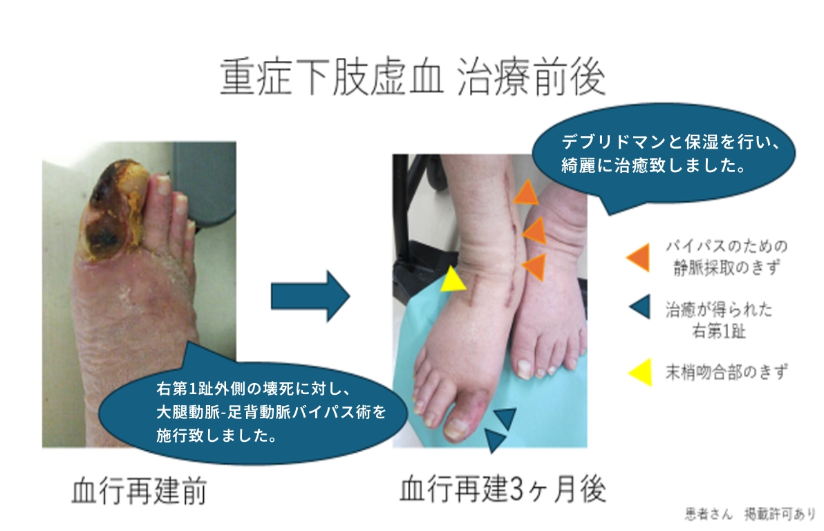 重症下肢虚血 治療前後