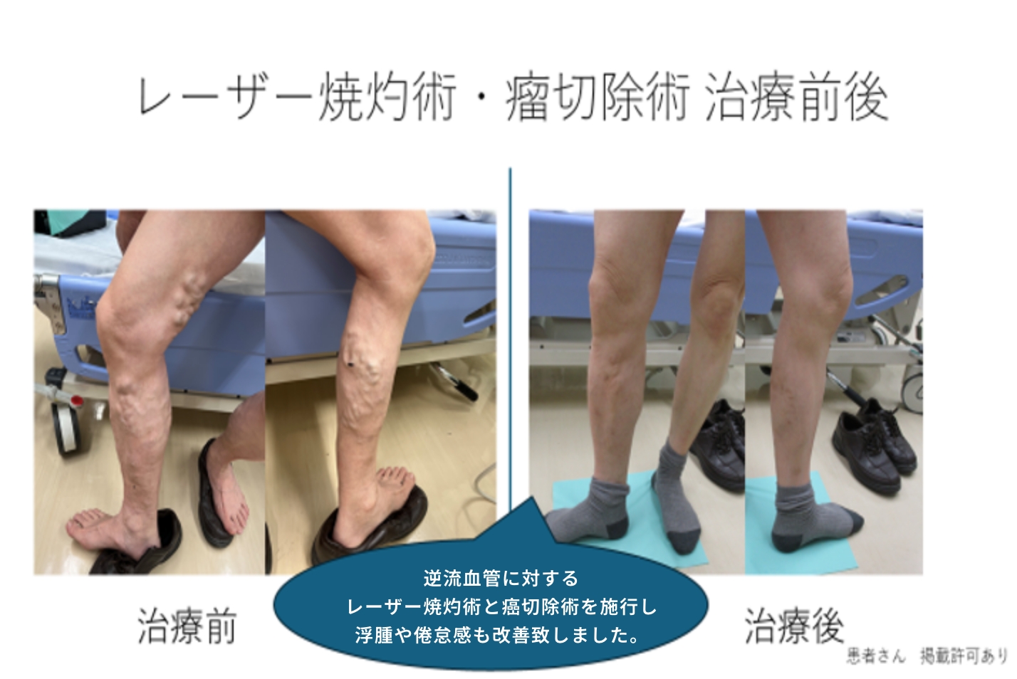 レーザー焼灼術・瘤切除術 治療前後