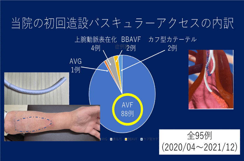 当院の初回造設バスキュラーアクセスの内訳