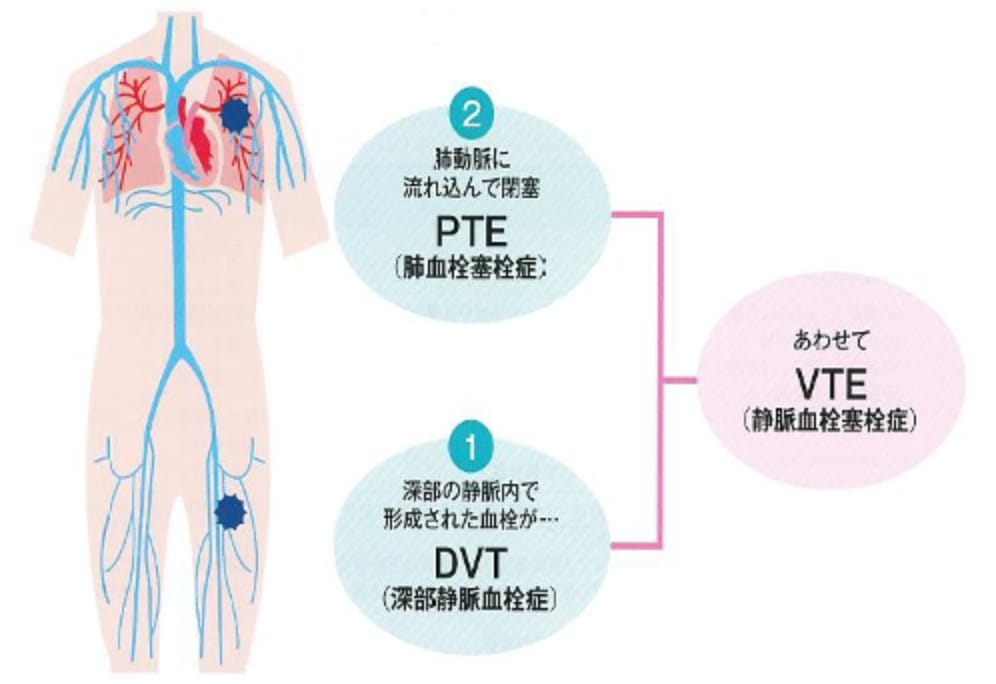 静脈血栓症イメージ