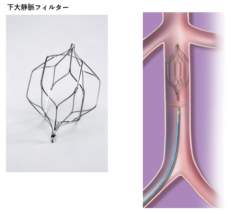 下大静脈フィルター