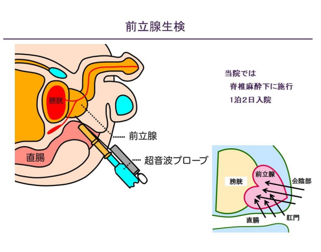前立腺生検