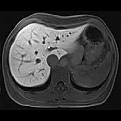 肝臓MRI